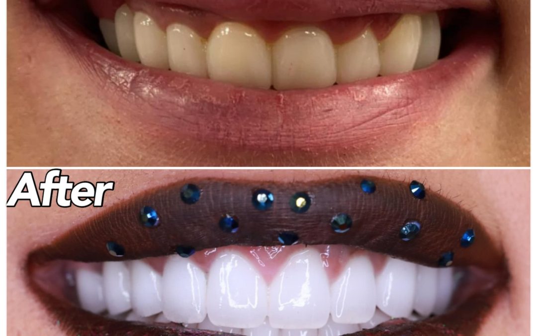 top lucruri interesante despre coroanele dentare